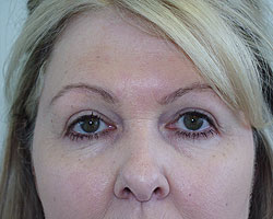 eyelid bna after 01